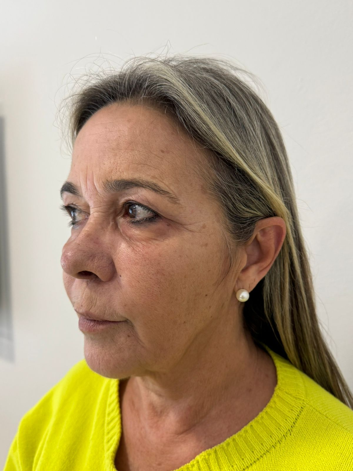 Antes da harmonização